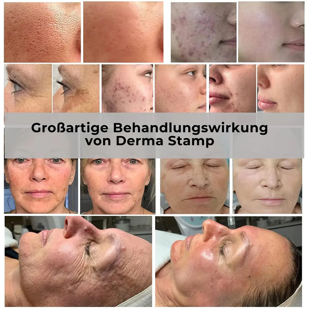 Une peau éclatante commence par les bio-aiguilles.