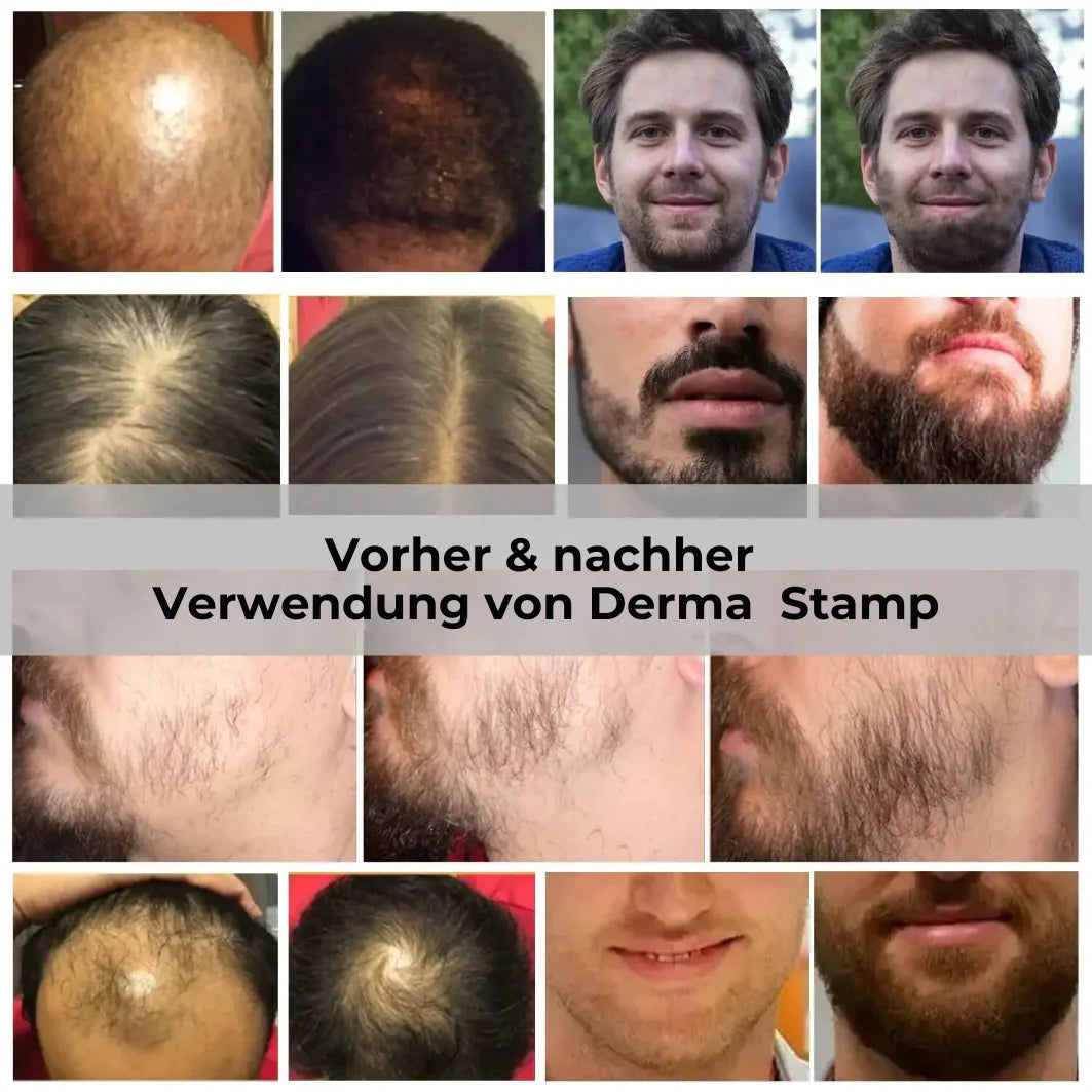 Une peau éclatante commence par les bio-aiguilles.